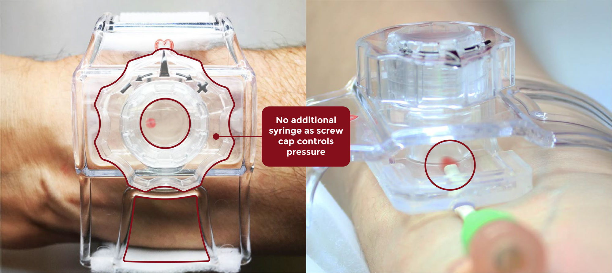 No additional syringe as screw cap controls pressure